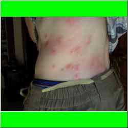 bedbug-bites-on-bus-from-pune-bangalore.jpg
