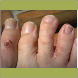 athletes-foot.JPG